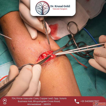 AV Fistula Surgery in Ahmedabad - Specialist Care by Dr. Krunal Gohil AV Fistula Surgery in Ahmedabad - Specialist Care by Dr. Krunal Gohil