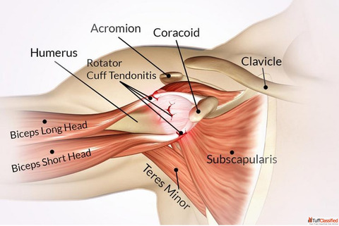 Right Shoulder Pain Cure with Effective Homeopathy Medicine Right Shoulder Pain Cure with Effective Homeopathy Medicine