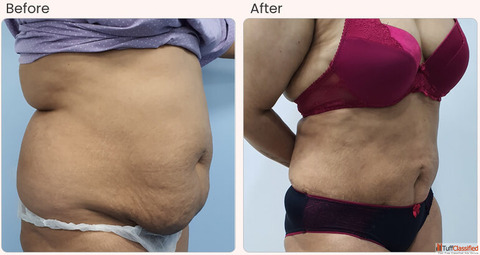 Liposuction Surgery in Delhi - Dr Rajat Gupta Liposuction Surgery in Delhi - Dr Rajat Gupta