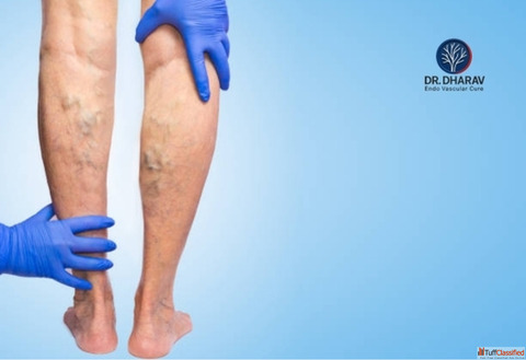 Restore Healthy Legs with Varicose Veins Treatment in Mumbai by Dr. Dharav Kheradia Restore Healthy Legs with Varicose Veins Treatment in Mumbai by Dr. Dharav Kheradia