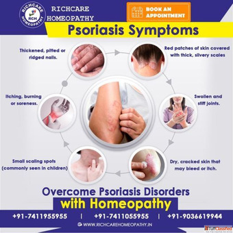 Signs symptoms of Psoriosis Homeopathy treatments in Bangalore