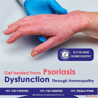 Signs symptoms of Psoriosis Homeopathy treatments in Bangalore