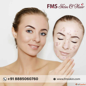 Vampire Facial Treatment In Hyderabad