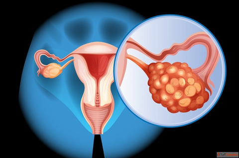 Top Rated Surgeons for Ovarian Cancer Surgery in Ahmedabad