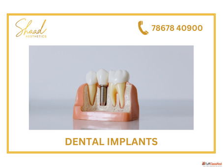 Tooth implants in coimbatore Shaadaesthetics dental clinic