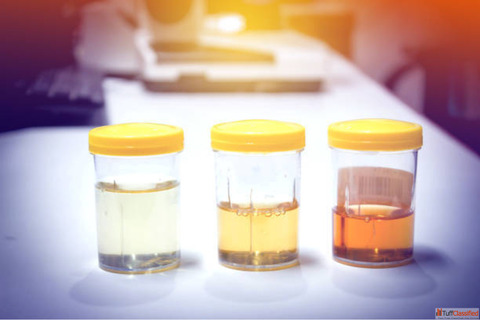 Need Top Rated Female Urine Collection Container For Patients and Laboratory