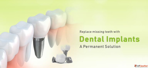 Painless Dental Implants in India