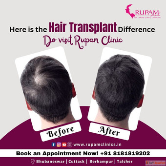 Best Hair Transplant Treatment Clinic Bhubaneswar - Rupam Clinic