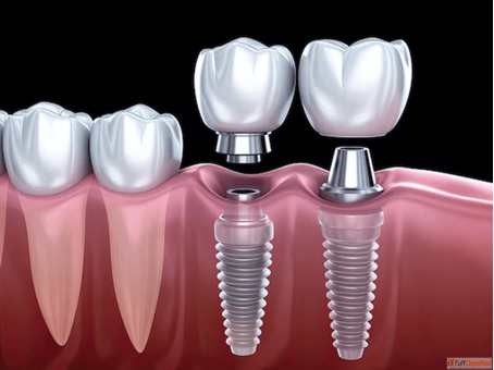 Dental Implants in Indirapuram ghaziabad - Dr Khan Dental Clinic