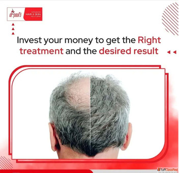 Hair Baldness Treatment Clinic Gurgaon - Regrow with Confidence