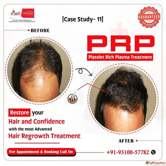 PRP Microneedling Facial in Gurgaon - Skin Renewal