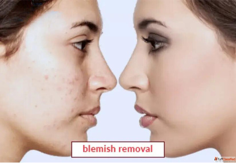 Blemish Removal Treatment Professional Cosmetology Solutions