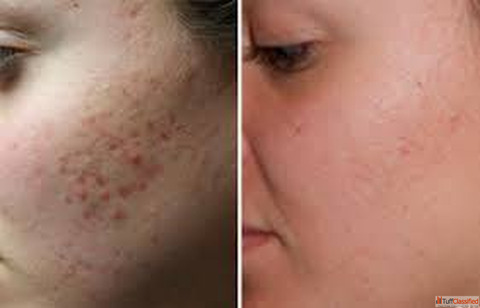 Acne Scars Treatment