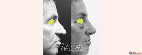 Celebrity Rhinoplasty Surgery in Delhi Enhance Your Beauty
