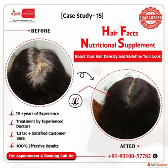 Women's Hair Regrowth Treatment in Gurgaon - Safe Proven