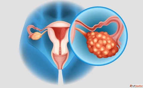 PCOD Treatment in India Best Doctors Clinics Solutions