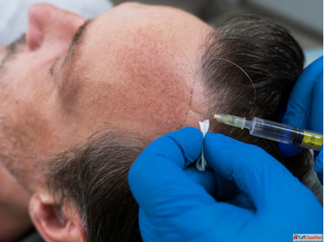 PRP Hair Treatment in Lucknow
