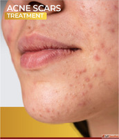 Effective Acne Scar Treatments in Delhi Your Guide to Cleare...