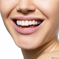 Hollywood Smile Design in Dubai