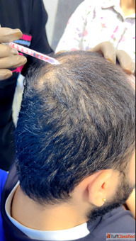 PRP Skin Treatment in Lucknow
