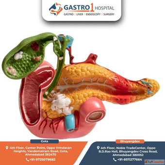 Find The Best Acute Pancreatitis Treatment Doctor in Ahmedabad