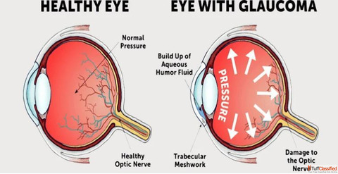 Top Eye Specialists for Glaucoma Treatment in Mumbai