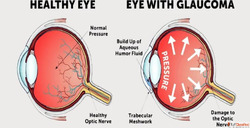 Top Eye Specialists for Glaucoma Treatment in Mumbai