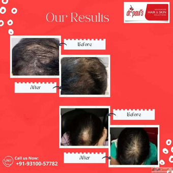 Hair Fall Solutions in Gurgaon - Restore Strengthen