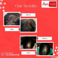 Hair Fall Solutions in Gurgaon - Restore Strengthen