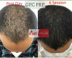 Men's Hair Loss Clinics in Gurgaon - Customized Solutio...