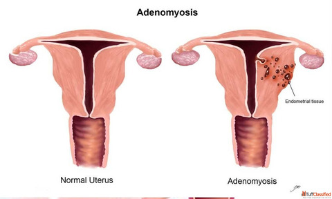 Best Adenomyosis Treatment Doctors In Delhi