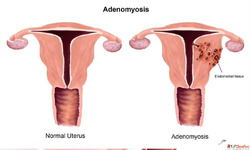 Best Adenomyosis Treatment Doctors In Delhi