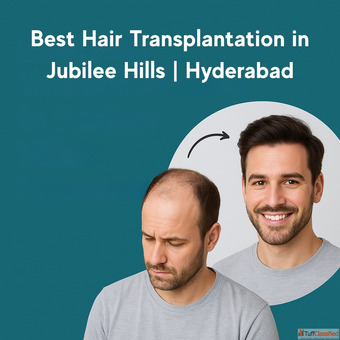 Best Hair Transplantation in Jubilee Hills Hyderabad