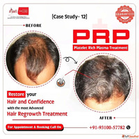 Men's Hair Regrowth Solutions in Gurgaon - Regain Confi...