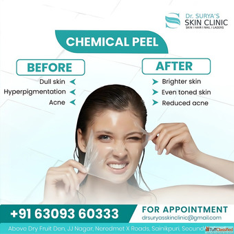 Say Goodbye to Stubborn Spots - Get the Best Pigmentation Treatment in Secunderabad