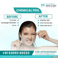 Say Goodbye to Stubborn Spots - Get the Best Pigmentation Tr...