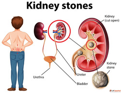 Best Kidney Homeopathic Doctor in India - Trusted Care That ...
