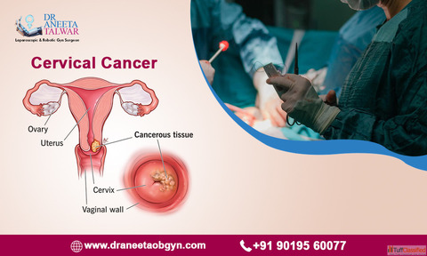 Best Cervical Cancer Treatment Doctor in Whitefield Manipal
