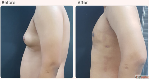 Gynecomastia Surgery Cost in Delhi - Dr Rajat Gupta