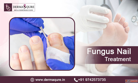 Effective Fungus Nail Treatment in Bangalore