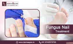 Effective Fungus Nail Treatment in Bangalore