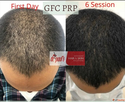 Affordable Hair Fall Treatment Clinic in Gurgaon