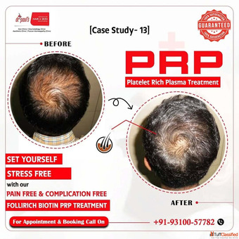 Hair Transplant or PRP Free Consultation in Gurgaon