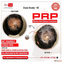 Hair Transplant or PRP Free Consultation in Gurgaon