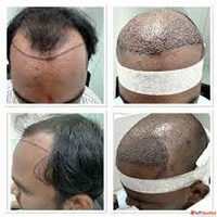 Fue Hair Transplantation in Kondapur