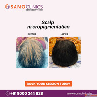 Hair Transplantation in Kondapur