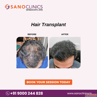 Hair Transplantation in Hitech City