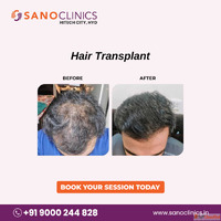 Hair Transplantation in Hitech City