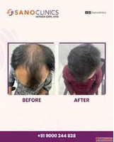 Hair Transplantation Clinic in Hitech City
