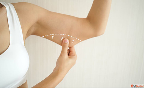 What You Need to Know About Arm Lift Surgery